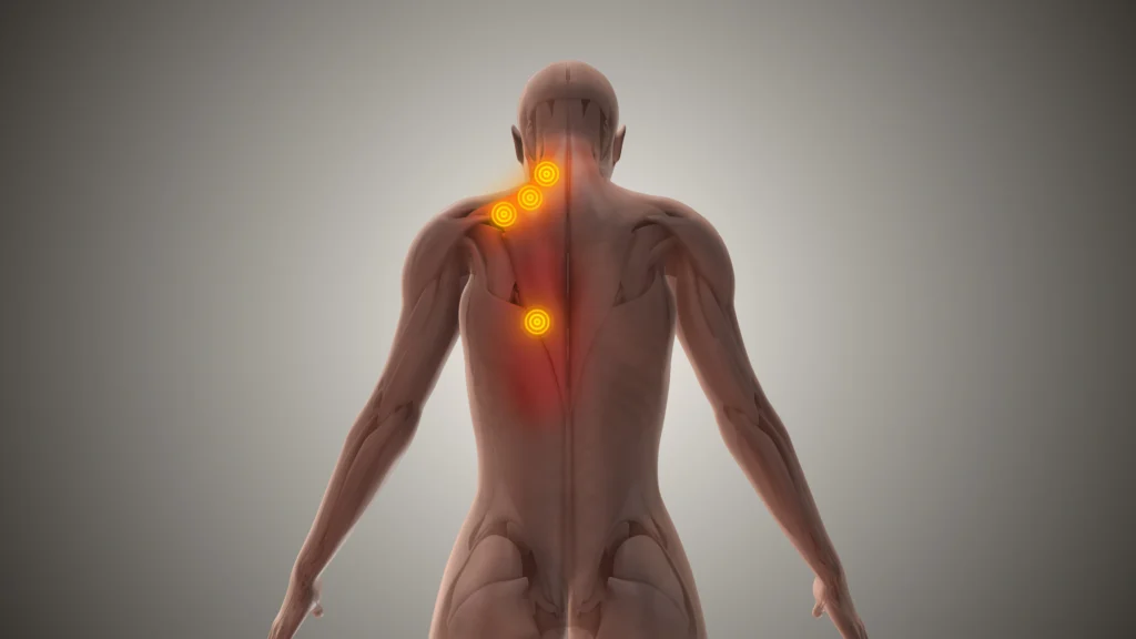 CBD For pain relief illustration showing pain points on a back